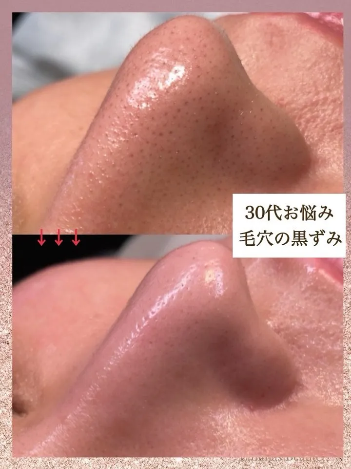 毛穴のお悩み、もうさよならしませんか？ 