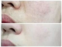 30代  敏感肌の根本肌質改善
