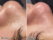30代 毛穴洗浄＋お顔全体WAX