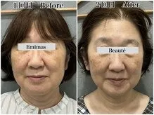  50代 毛穴洗浄＆幹細胞2回目