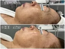 60代 毛穴洗浄＆幹細胞
