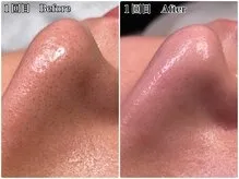 30代半ば 小顔矯正＆毛穴洗浄