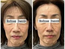 60代後半 小顔矯正＆幹細胞