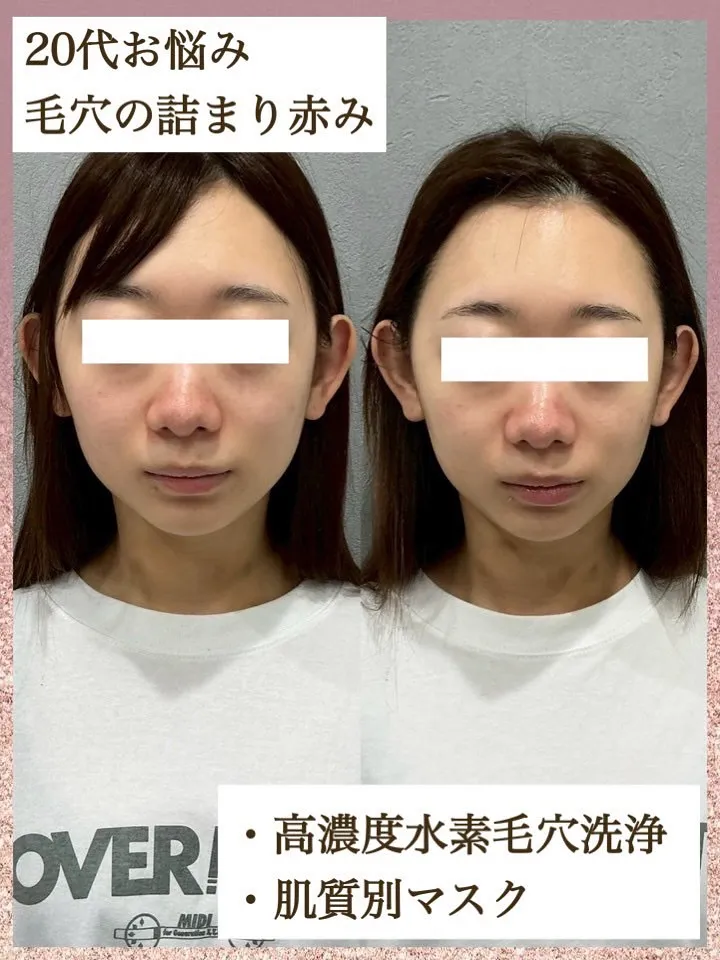 ２０代前半の元々とっても小顔なお客様🩷