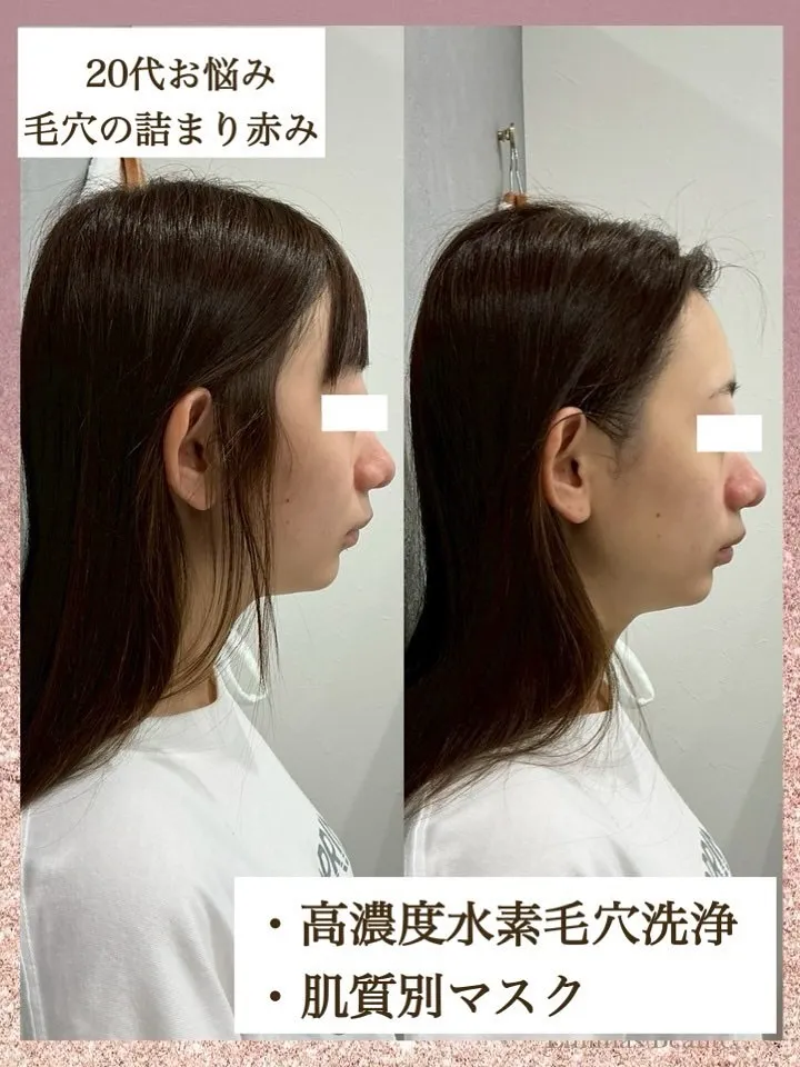 ２０代前半の元々とっても小顔なお客様🩷