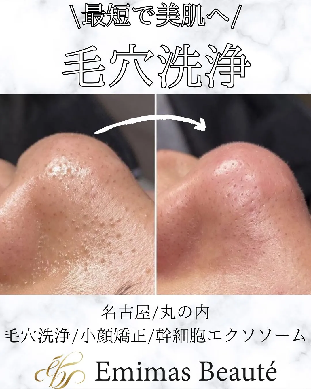 正しい毛穴ケアが健康美肌への近道