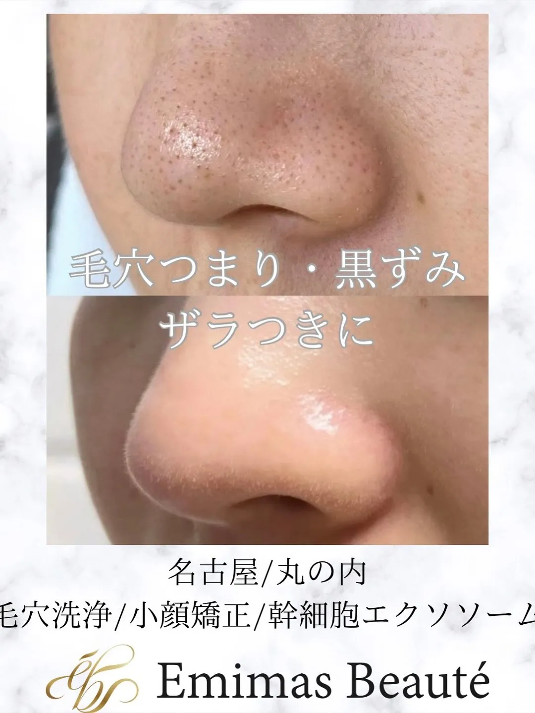 毛穴洗浄でツルスベ肌へ♡