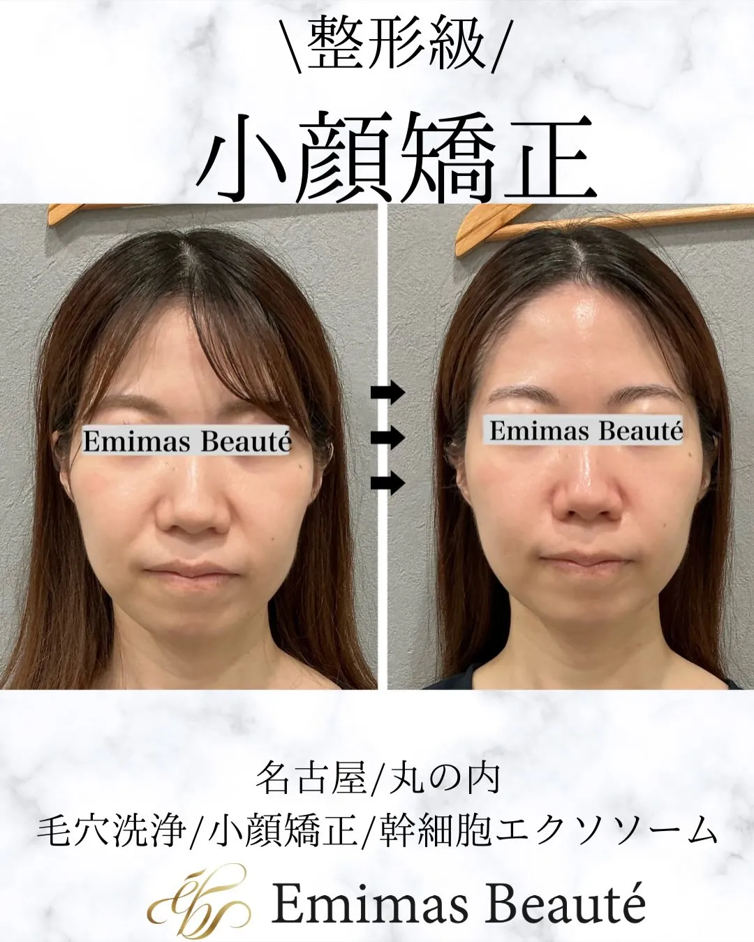 Emimas  Beauté の小顔矯正♡