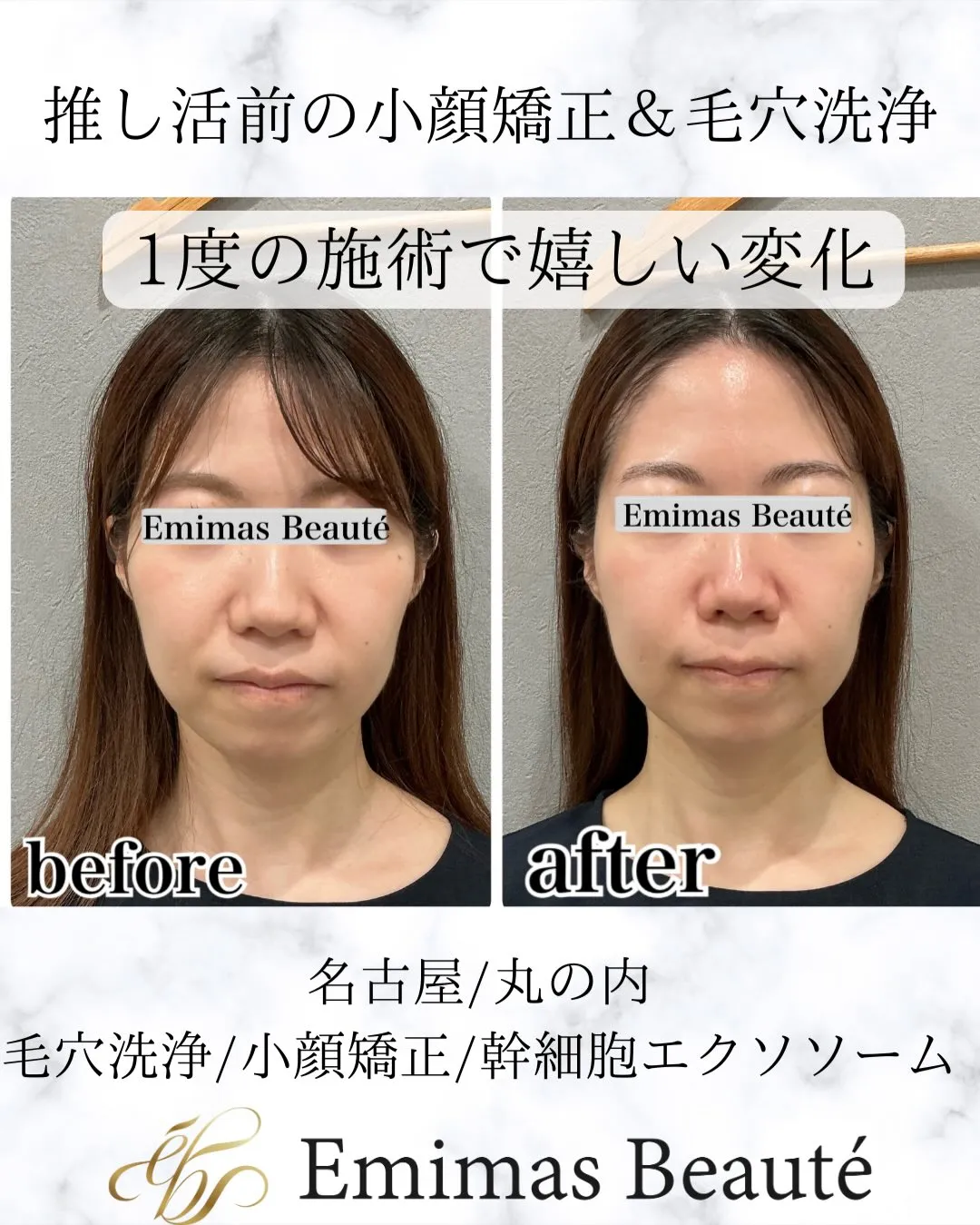 Emimas  Beauté の小顔矯正♡
