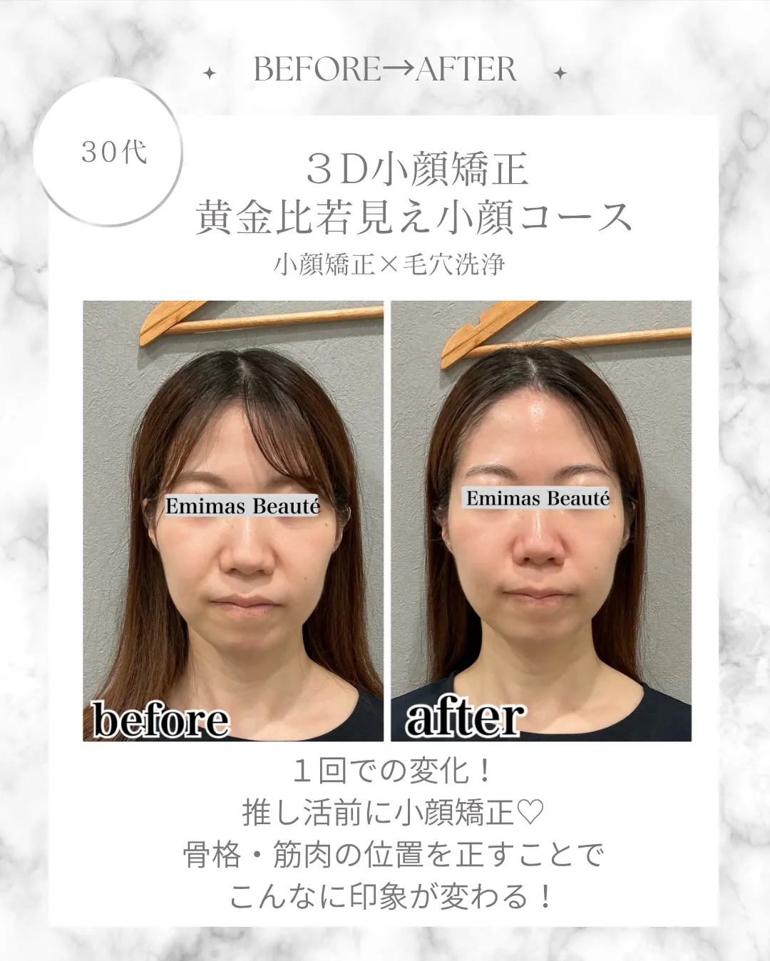 Emimas Beauté の小顔矯正♡