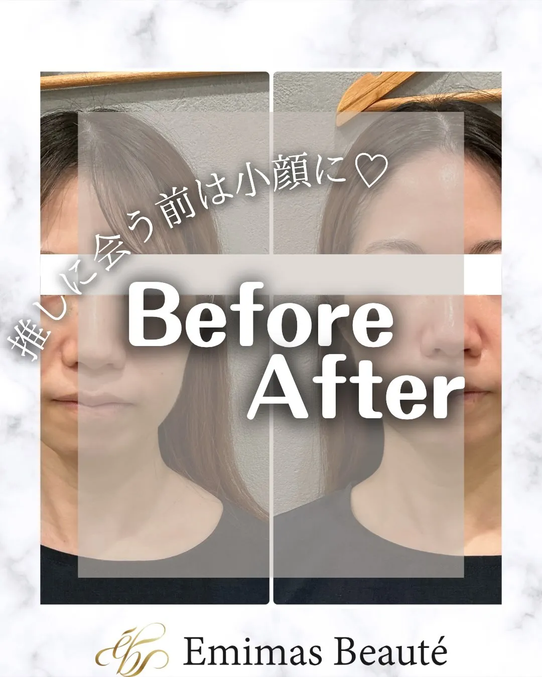 Emimas Beauté の小顔矯正♡