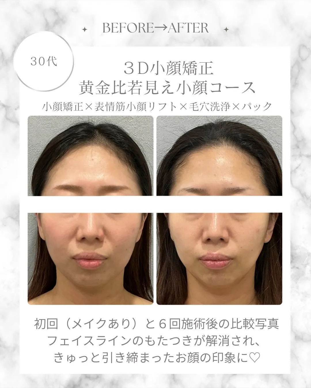 １ヶ月半の間に６回施術させていただきました！