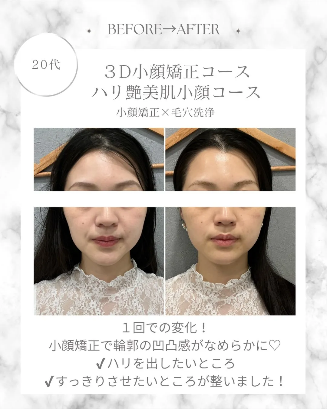 以前、食いしばりが気になり、１度ボトックスを施術されていた方...