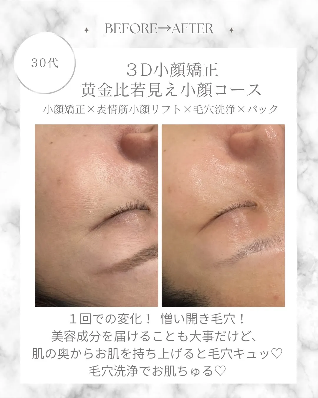 お悩みでもご相談が多い《頬のひらいた毛穴》