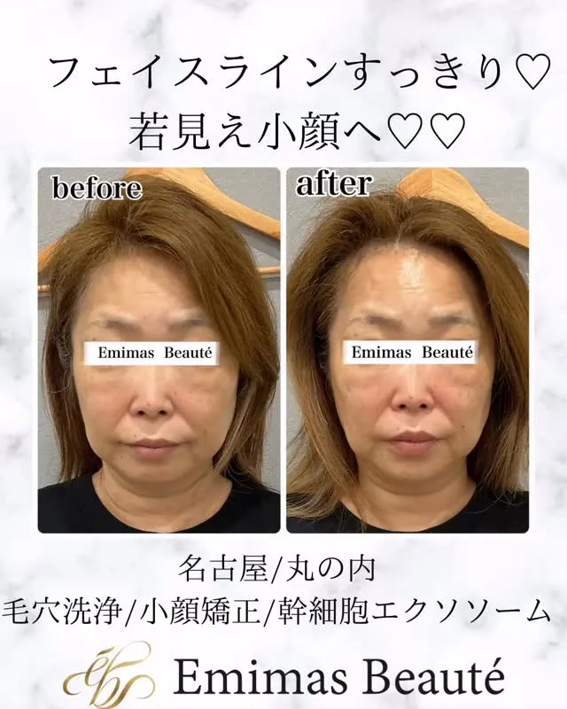Emimas  Beauté の小顔矯正♡♡